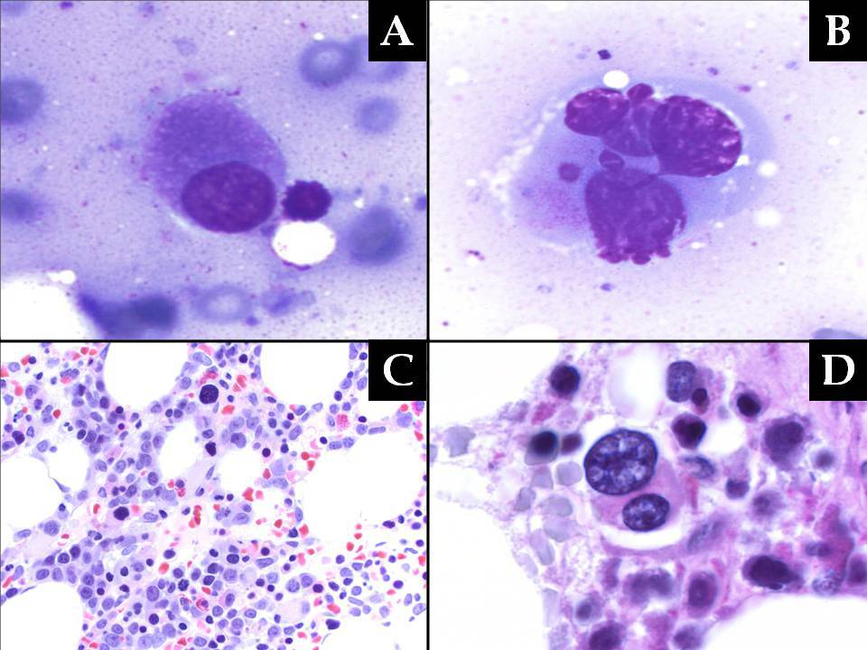 Megakaryocytes included many relatively small, hypobated forms (A, C), as well as some with multiple, discrete nuclei and/or internuclear bridging (B,D).